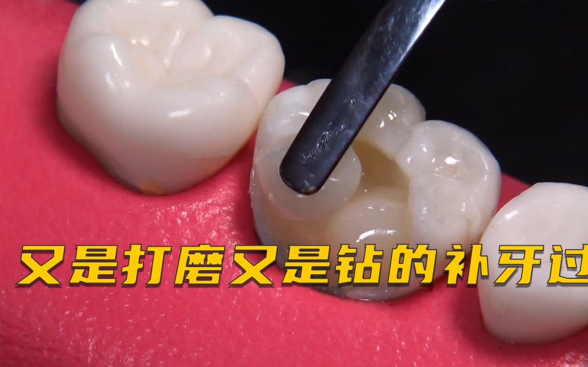 牙齿坏了一大半又是打磨又是钻最后修复成果惊艳