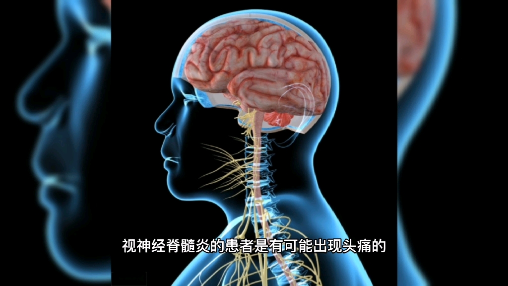 视神经脊髓炎患者会头痛么?