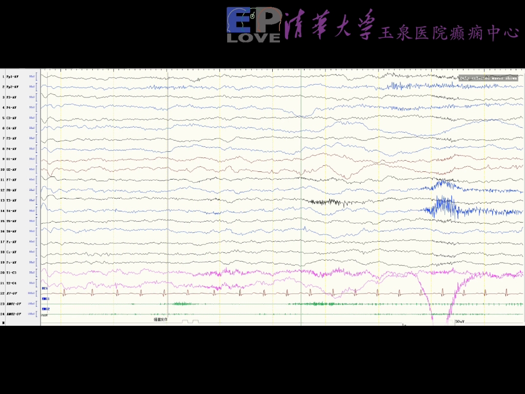 负性肌阵挛脑电图特点哔哩哔哩bilibili