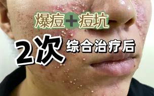 Tải video: 痘痘加痘坑，做了2次综合点阵激光后的变化