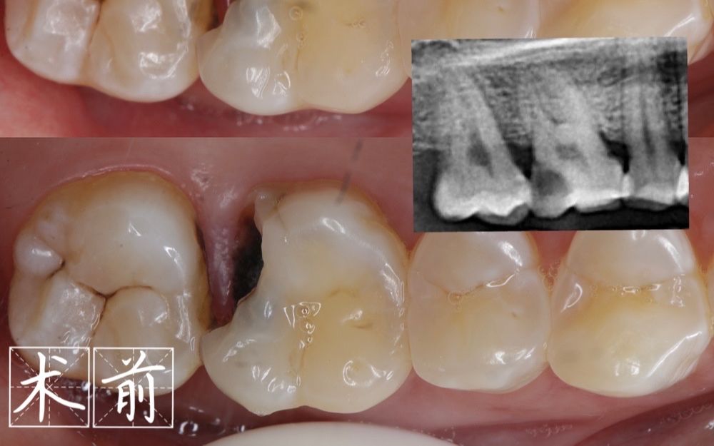 [图]深龋从直接盖髓到树脂充填