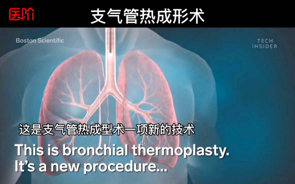 《八种手术简短介绍》,第二种:支气管热成形术.明显治疗难治性哮喘和重型哮喘,效果显著.#哮喘哔哩哔哩bilibili