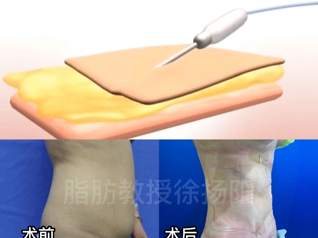 带你沉浸体验腰腹环吸全过程