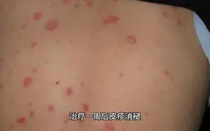 Download Video: 19岁大二女生恋爱半年染梅毒 疑因男友劈腿果断分手