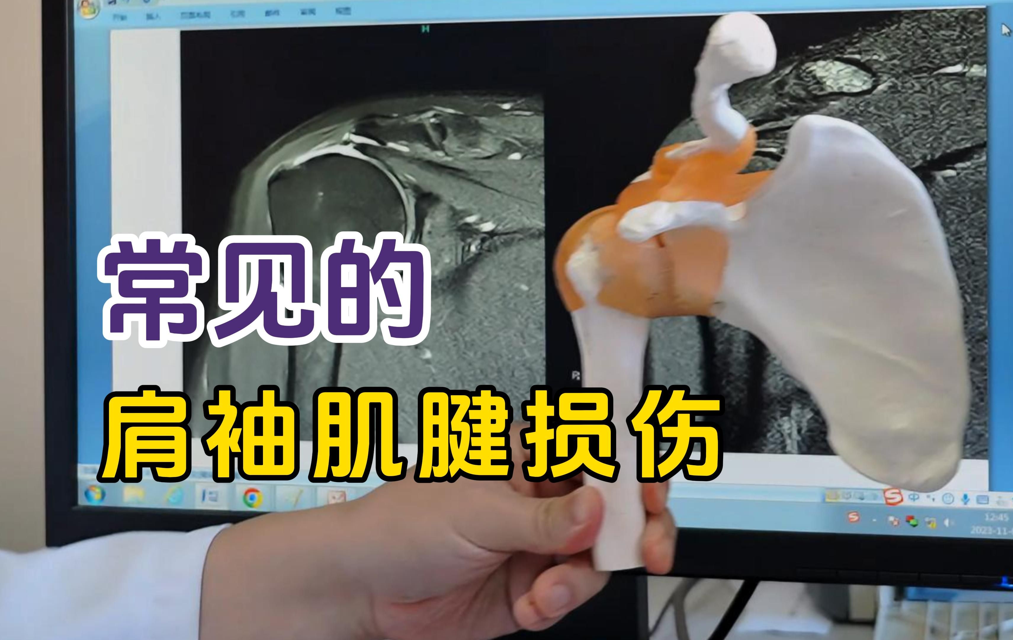 什么是肩袖损伤?李非博士科普常见的肩袖肌腱损伤