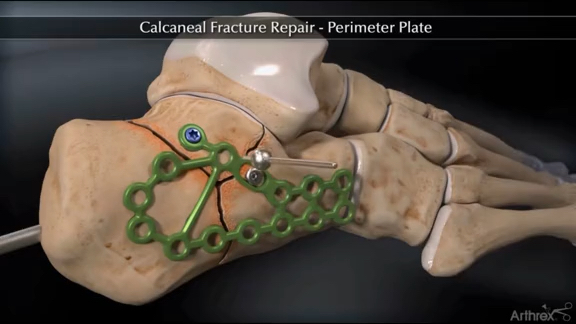 跟骨骨折钢板固定图片图片