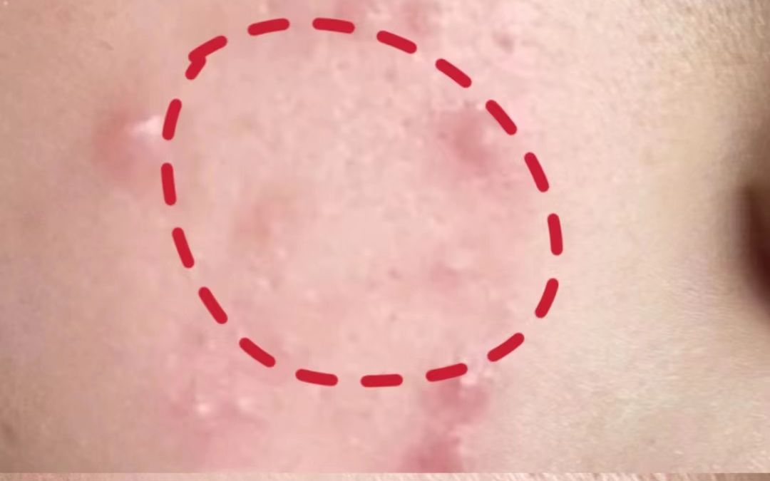 还在为祛痘净肤烦恼吗?治愈者手把手教你,摆脱油皮痘痘肌!