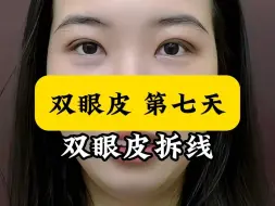 Download Video: 双眼皮第七天拆线..