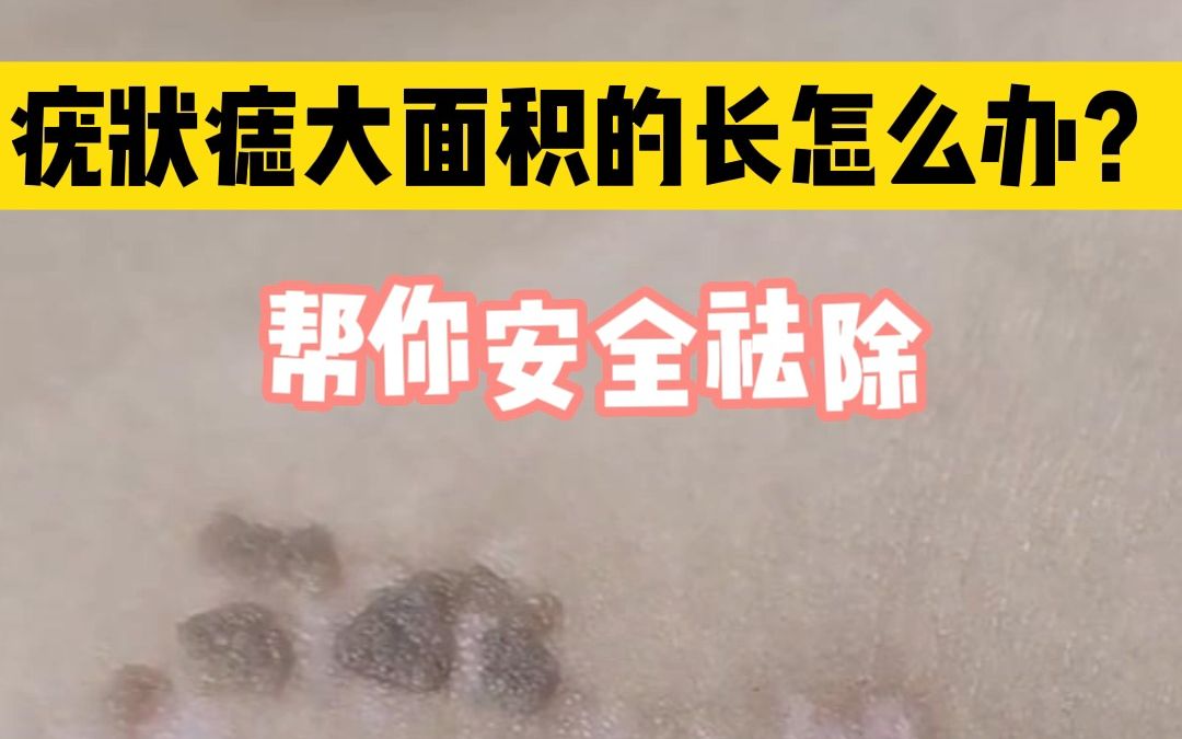 疣状痣又叫表皮痣,患儿会在出生时期或者是幼儿期就发病,有一部分患者会在1020岁可能才出现,男女的发病比例是相当的哔哩哔哩bilibili