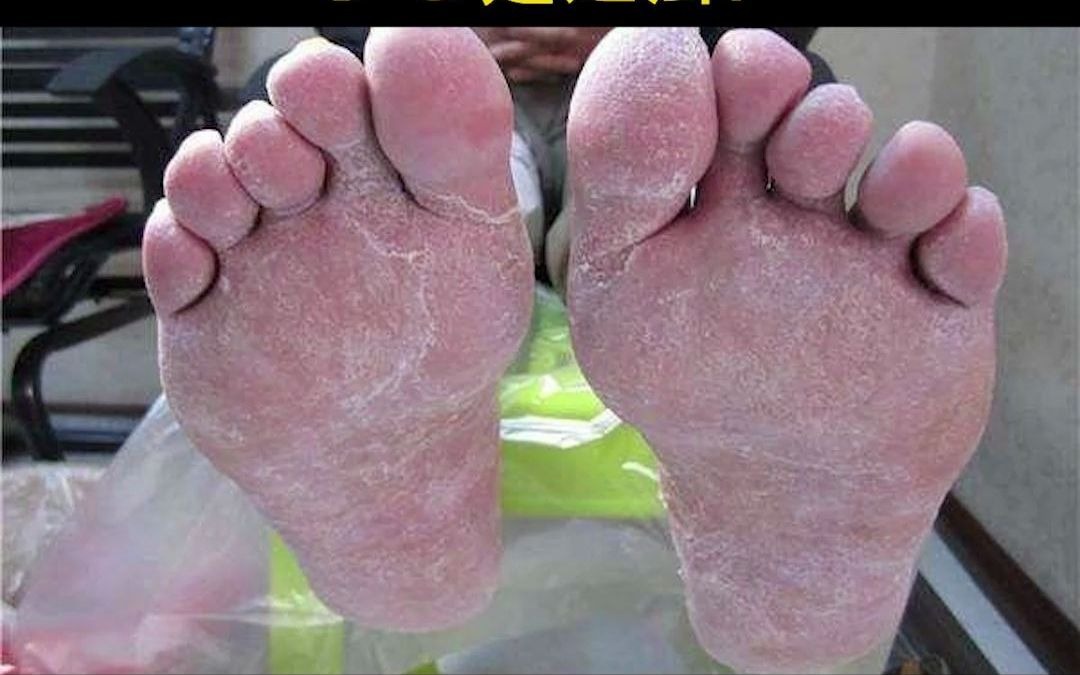 no50脚后跟经常干裂起皮小心是足癣应该怎么处理