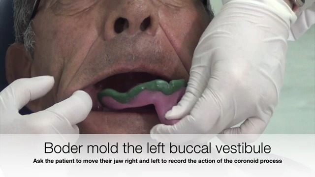 上颌终印模,全口义齿,边缘整塑,后堤区,发"啊"音,颤动线