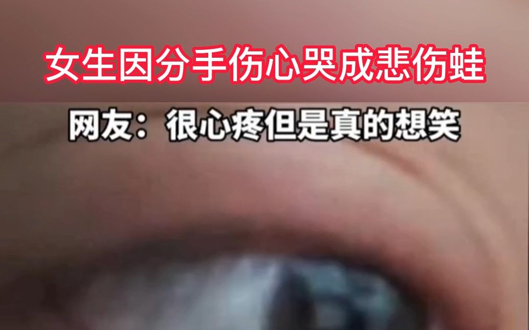 女生和男友吵架分手,哭3小时眼睛肿成"悲伤蛙",隔了一天才消肿.