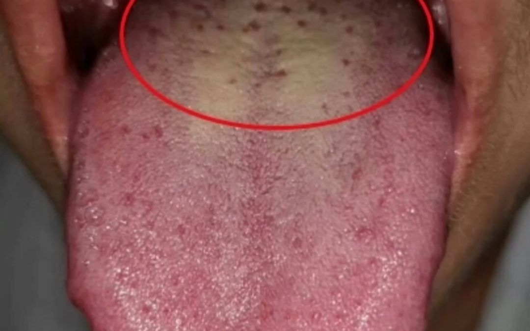肝胆湿热舌苔症状图片图片