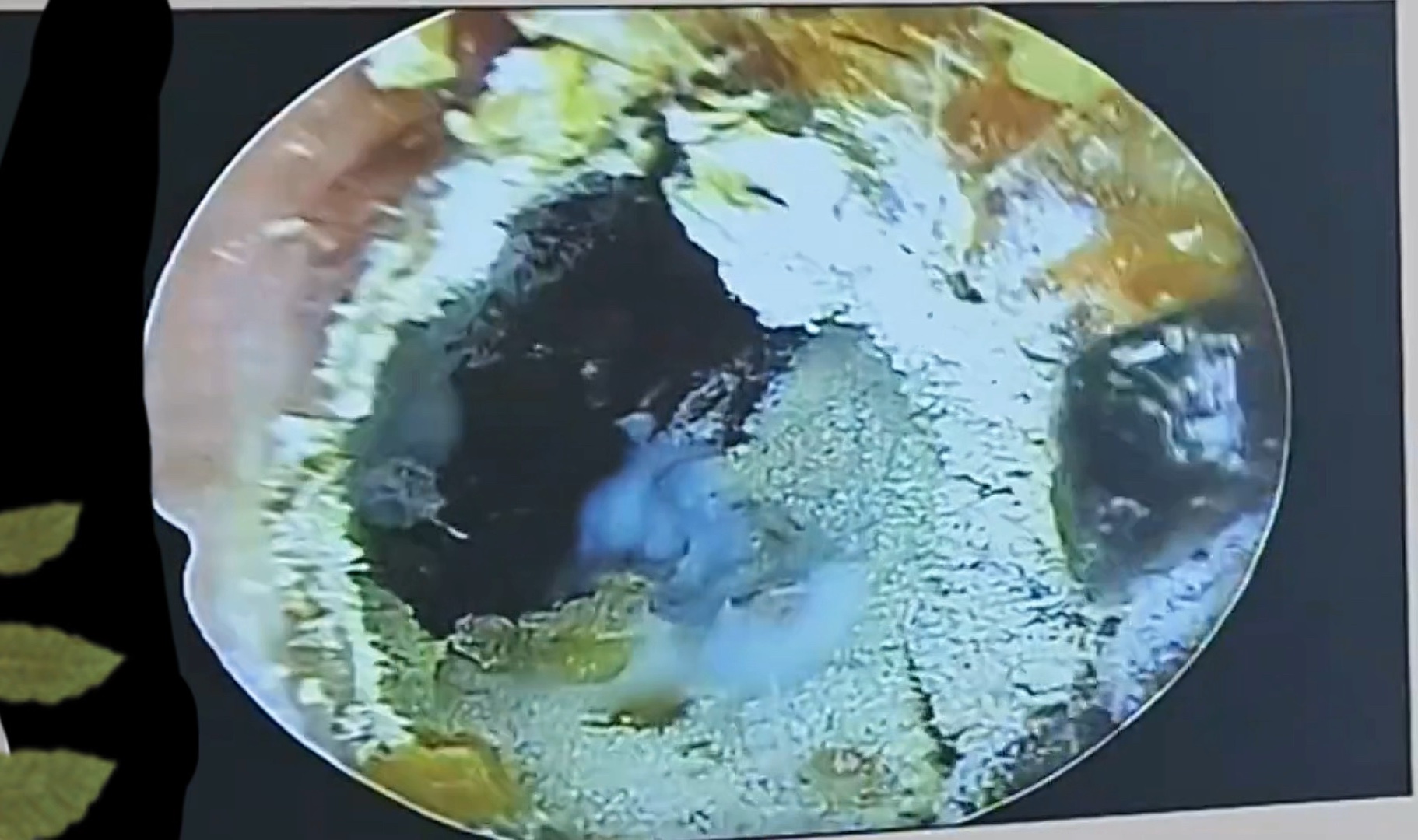 采耳解压;耳道里 密密麻麻的虫卵