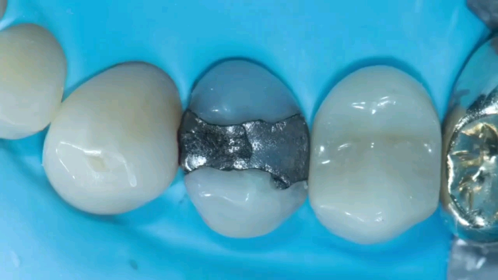 传统银汞合金补牙和现代化美学数脂补牙的区别一看便知