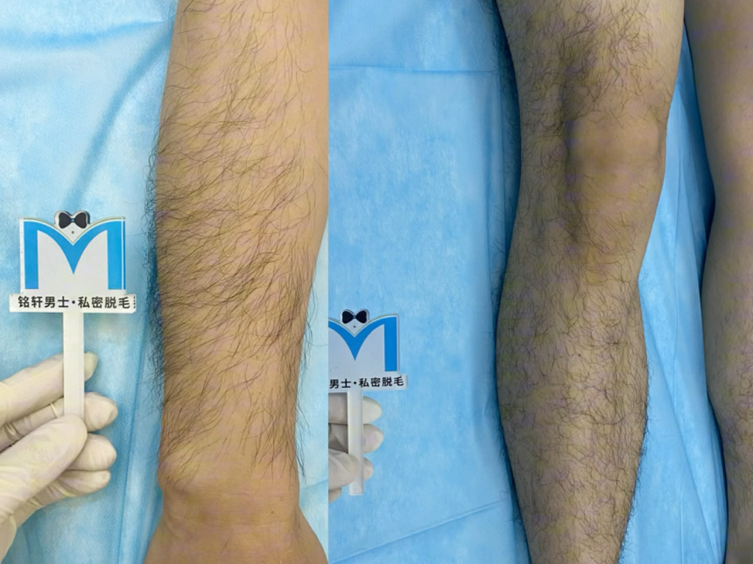 小哥哥脱毛开始,只要开始改变,一切就都不晚 #上海铭轩男士私密脱毛