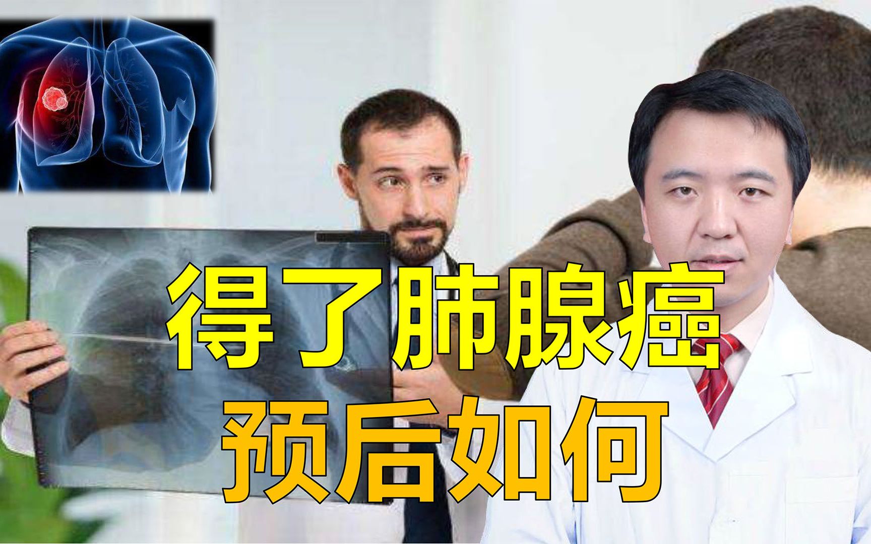 得了肺腺癌预后咋样?能够长期生存吗?听胸外科专家告诉你哔哩哔哩bilibili