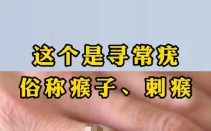 Download Video: 感染寻常疣不要自己抠，可能越抠越严重，专家教你如何处理