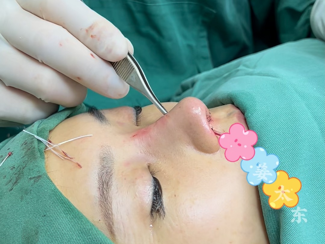 线雕鼻6年,术后即刻讲解