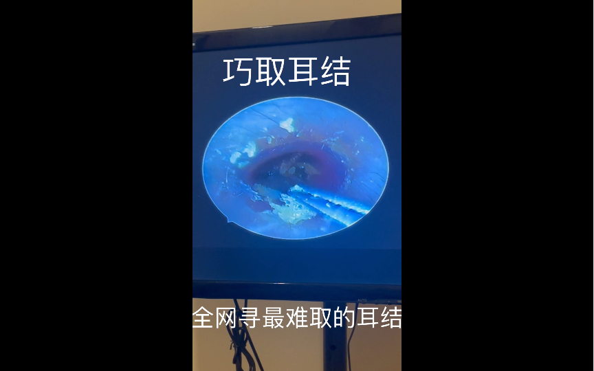 取耵聍栓塞,不求快,但求稳,太过瘾了哔哩哔哩bilibili