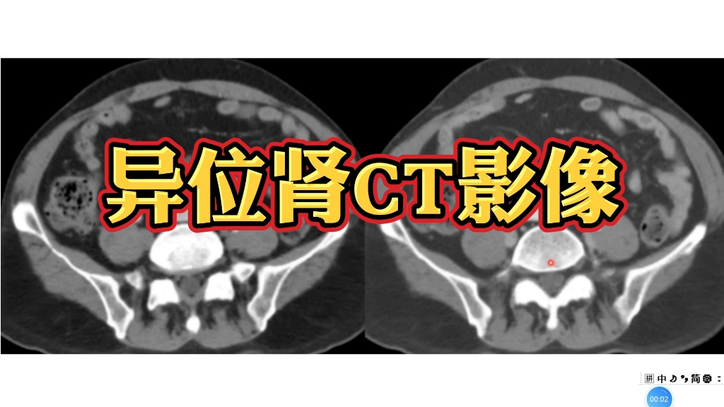 病例分享:异位肾CT影像,抓住典型特征!哔哩哔哩bilibili