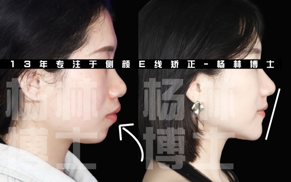 骨性嘴突下颌逆旋后,下巴更翘更尖了,秒变港风女生~牙齿矫正案例分享