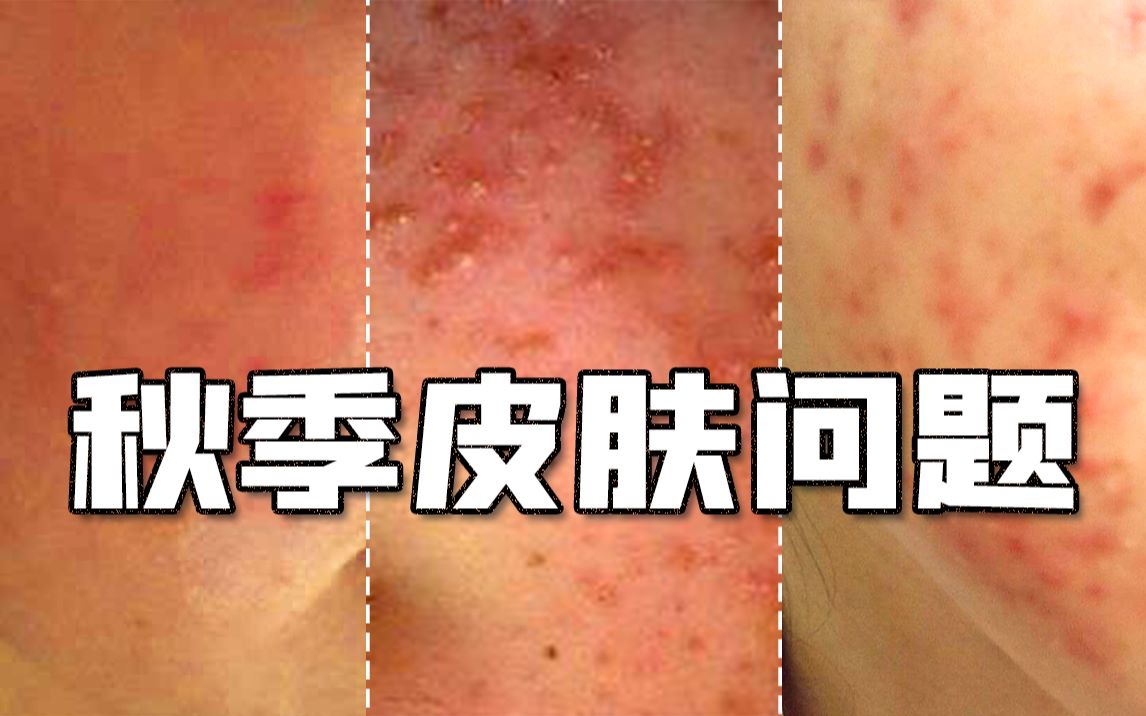 换季皮肤脆弱不堪,需要做到这些