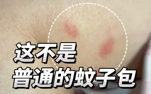 Download Video: 你以为只是被蚊子咬了吗？并不！等着你的还有……