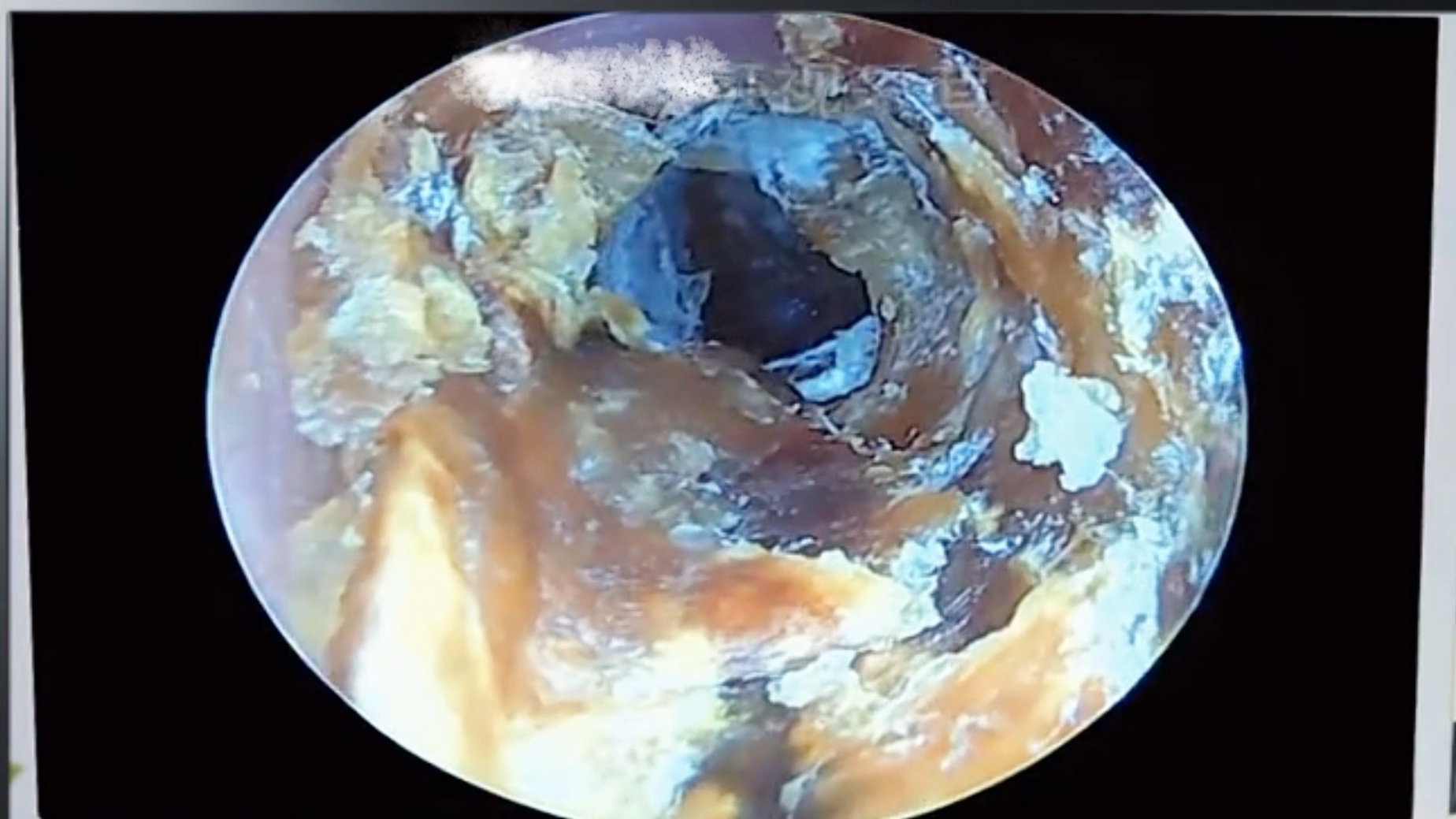 超级解压;大哥耳朵里好厚一层发霉的耳屎,把它全部清理出来