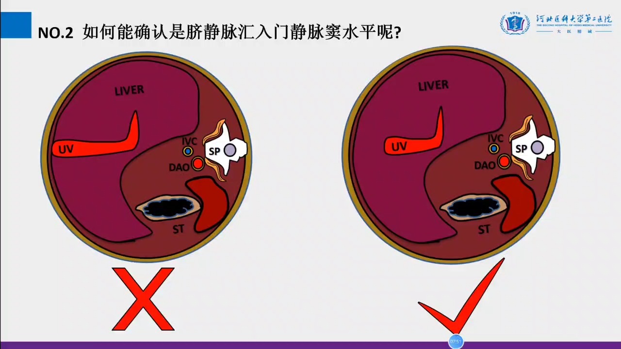 胎儿腹部常见畸形