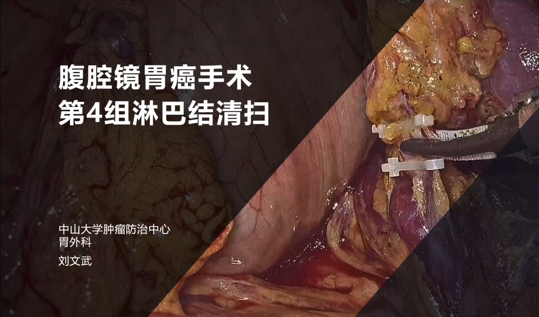 腹腔镜胃癌根治术第4组淋巴结清扫