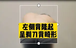 Video herunterladen: 12岁少女先天性脊柱侧弯，背部呈C型，如今脊梁挺直了