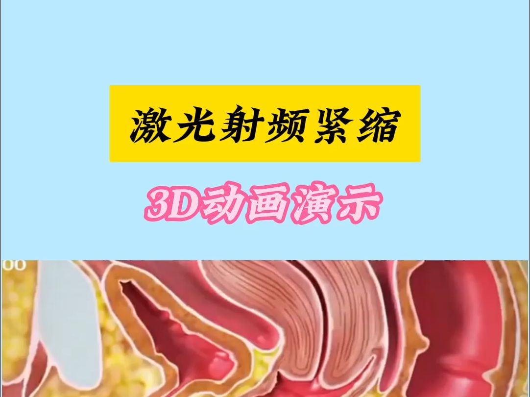 激光射频紧缩,3D动画演示哔哩哔哩bilibili