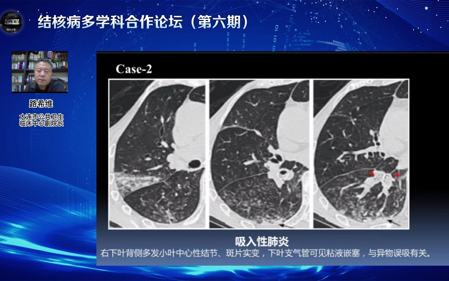 [图]【自学专用】肺结核的征象鉴别与活动性判断