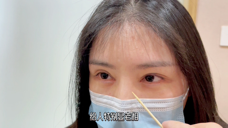 李冉医生内眼角修复顾客全程实拍