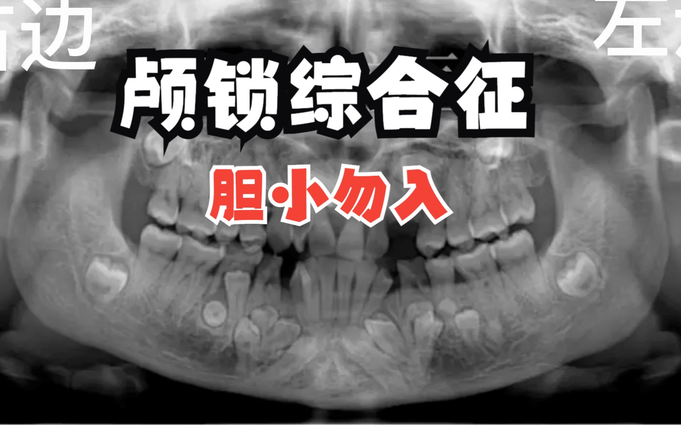 【智齿奇葩说】颅锁综合征了解一下,口腔表现让你瞠目结舌,胆小勿入
