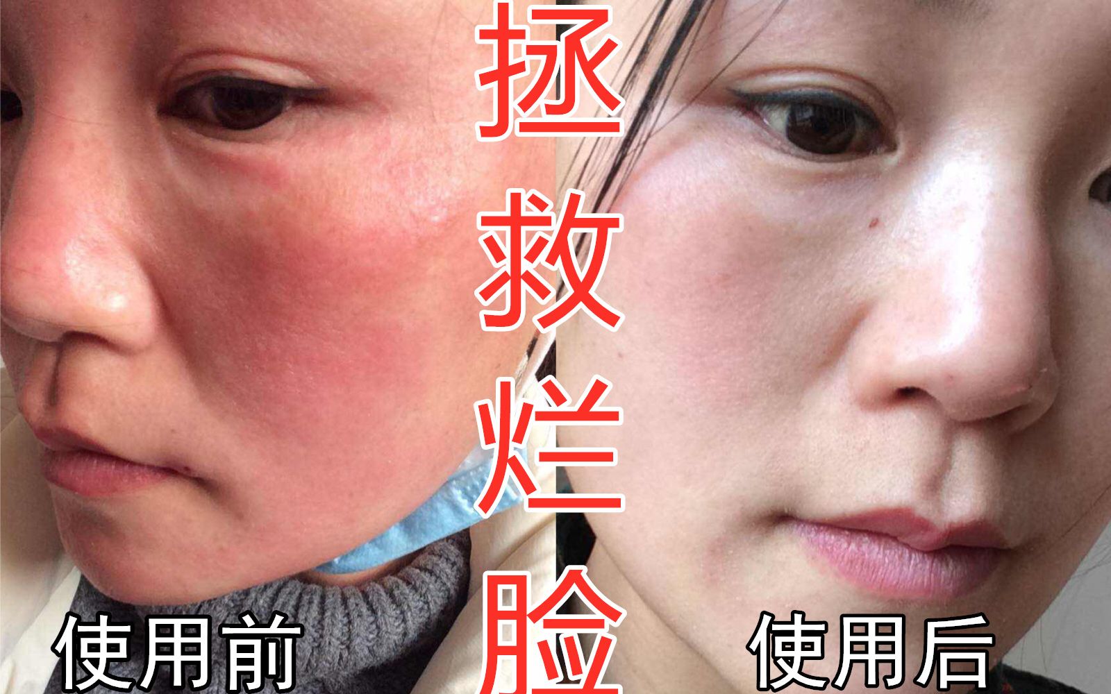 角质层薄,敏感肌肤,大红脸?70后小何姐教你一招,改善敏感肌
