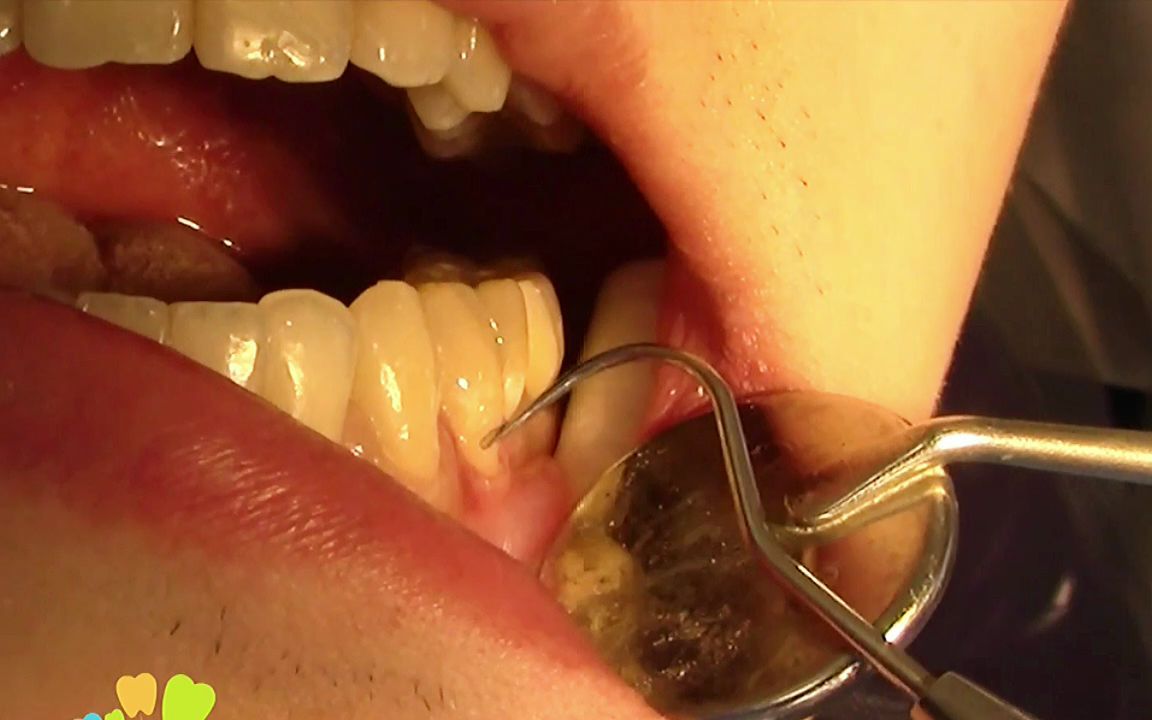 你们有没有牙齿上有一个明显的凹槽?