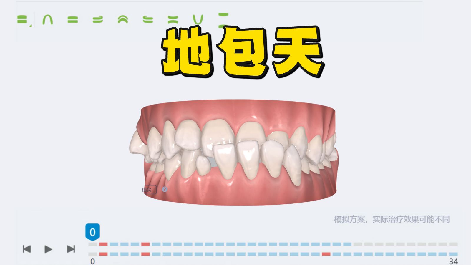 儿童地包天,如何设计矫正方案?