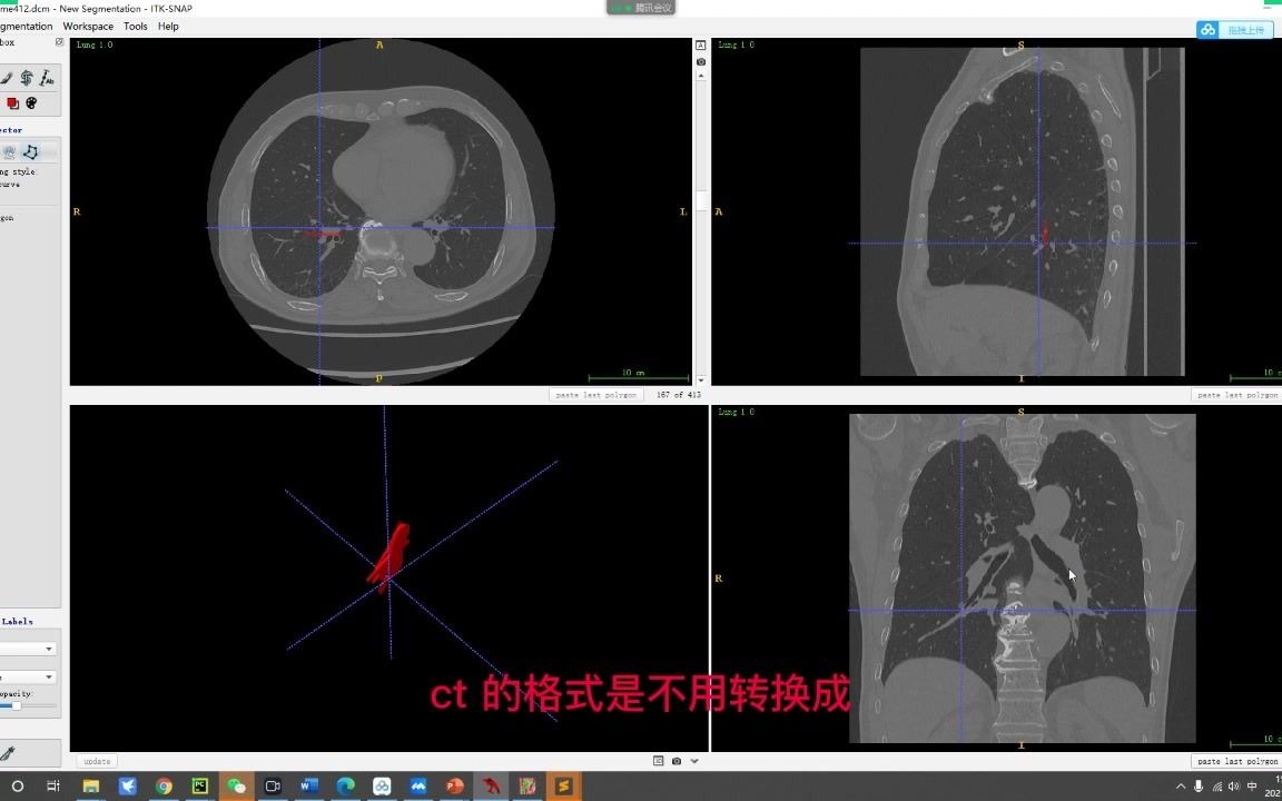 医学影像组学之3D数据的标注哔哩哔哩bilibili