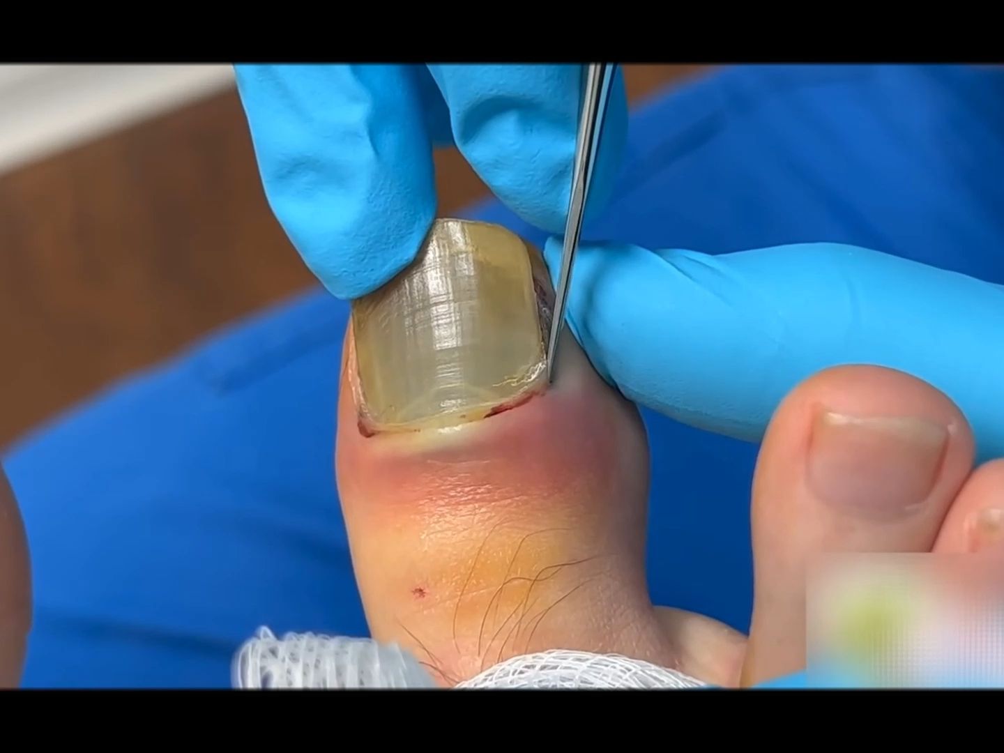 【甲沟炎】指甲被砸坏了,指甲拔掉-云一梨梨-默认收藏夹-哔哩哔哩视频