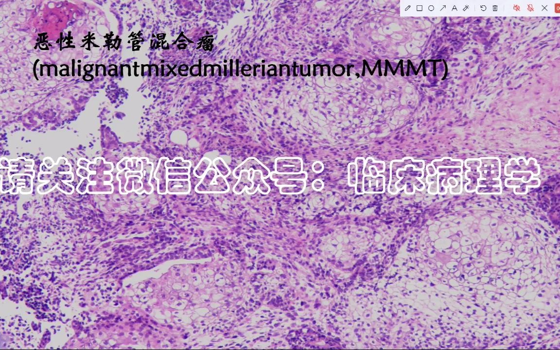 【快速病理阅片】恶性苗勒氏管瘤