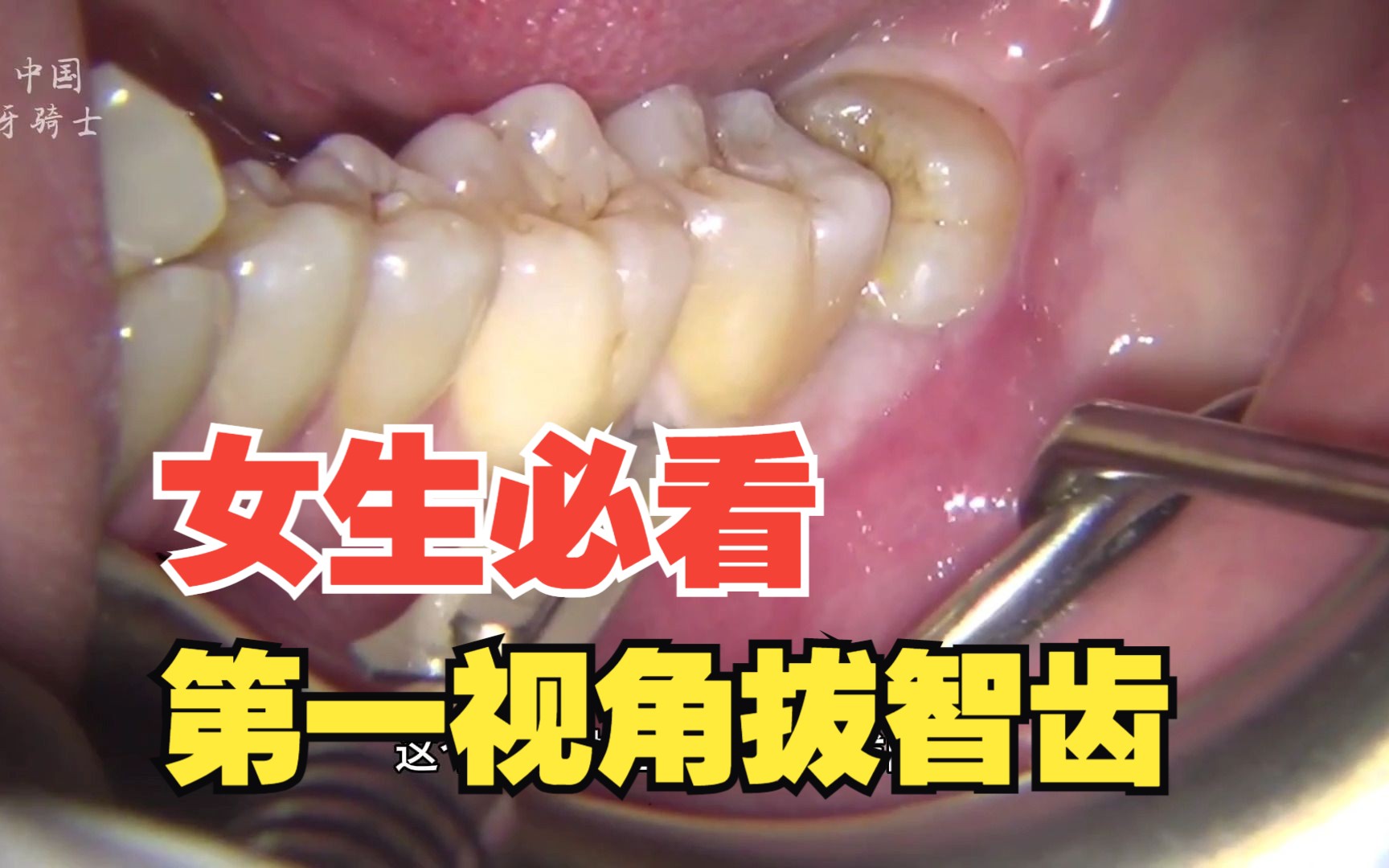 60帧超清,第一视角拔智齿,撬牙齿的那一刻,真是太刺激了!