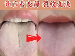 Video herunterladen: 舌苔厚腻到无苔，只用了一招