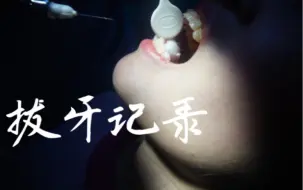 Tải video: 拔完了四颗牙后的真实感受是如何？？