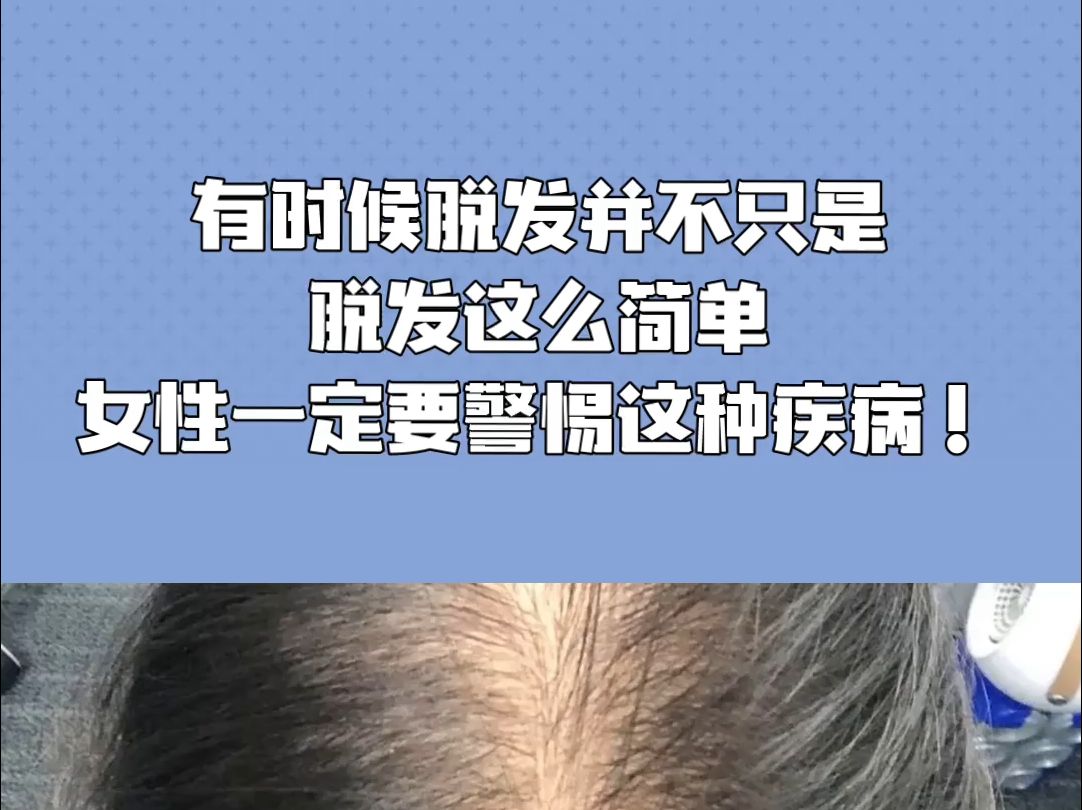 有时候脱发并不只是脱发这么简单,女性一定要警惕这种疾病!哔哩哔哩bilibili