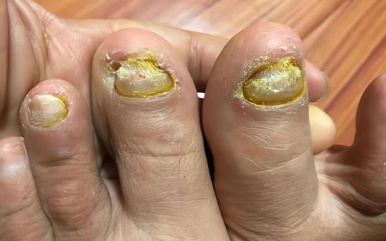 治好灰指甲,真的不难!康复者无偿分享自用秘籍,学会不花冤枉钱