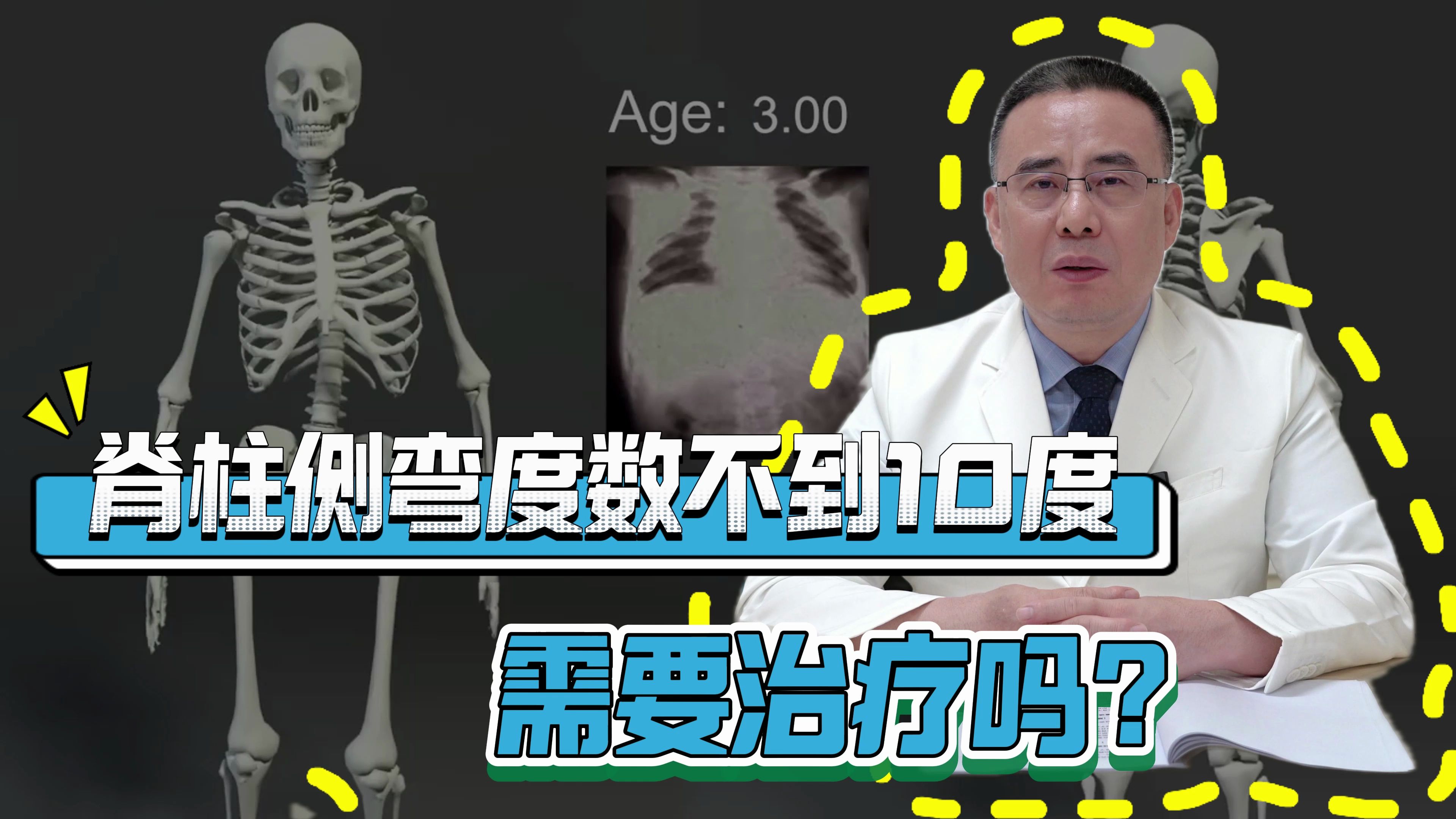 脊柱侧弯的度数不到10度,需要治疗吗?哔哩哔哩bilibili