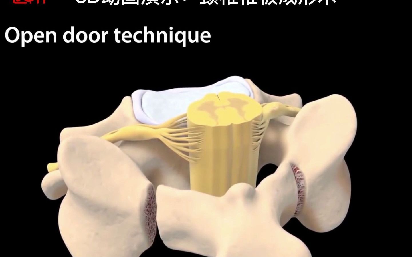 3d医学动画颈椎椎板成形术