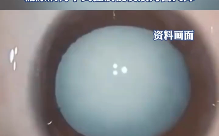 25岁小伙双眼瞳孔一夜之间全白,每天至少两瓶饮料,爱吃火锅